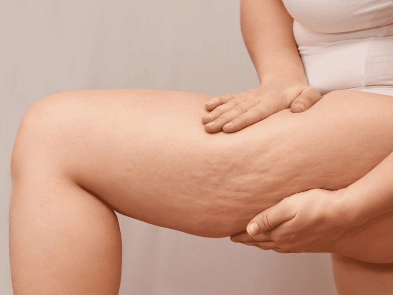 Combatir la celulitis con remedios naturales