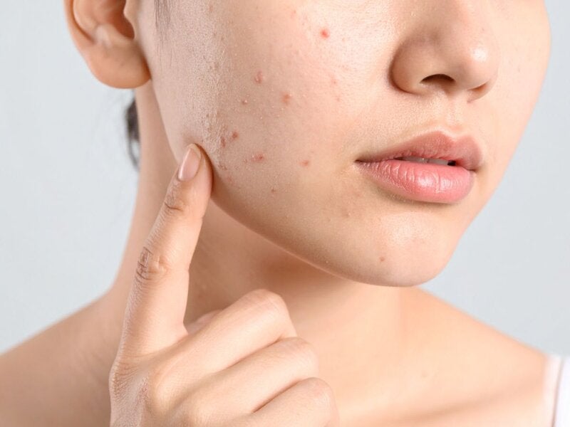 Manchas de la cara: cómo quitarlas y qué crema usar