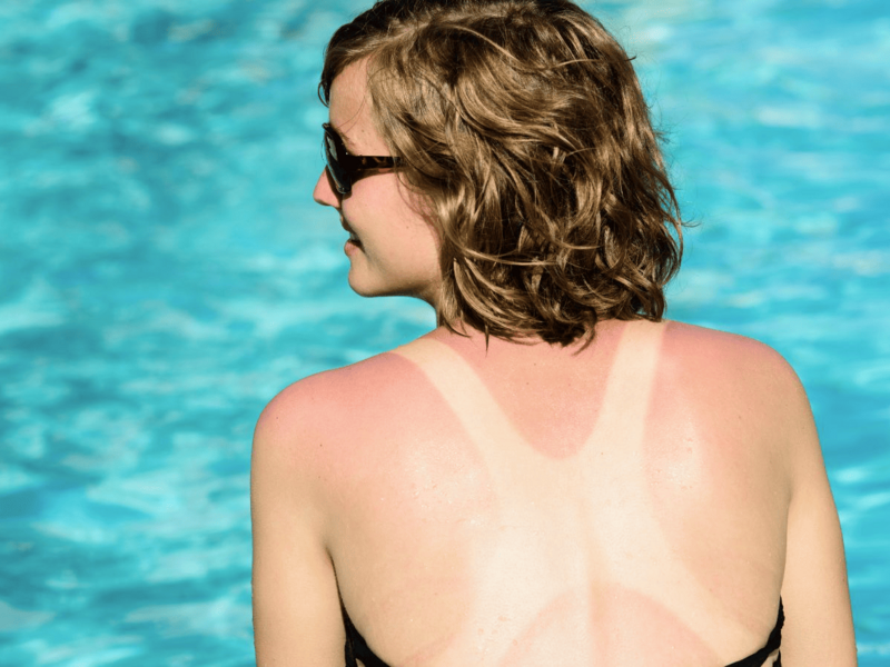 Cómo aliviar quemaduras de sol: guía efectiva y productos naturales