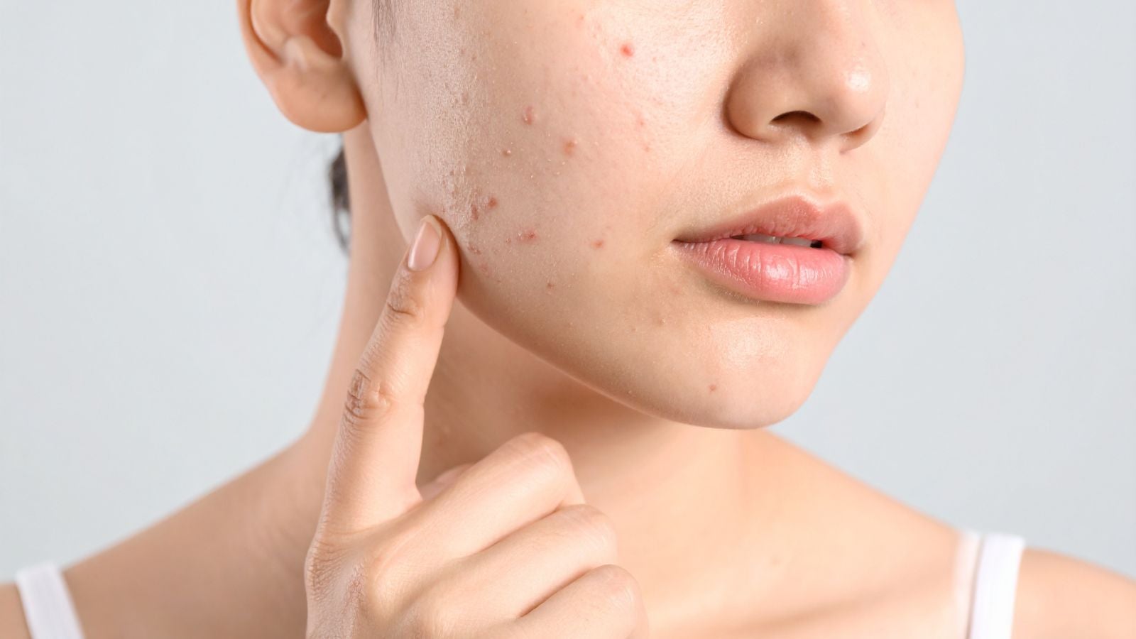 Manchas de la cara: cómo quitarlas y qué crema usar