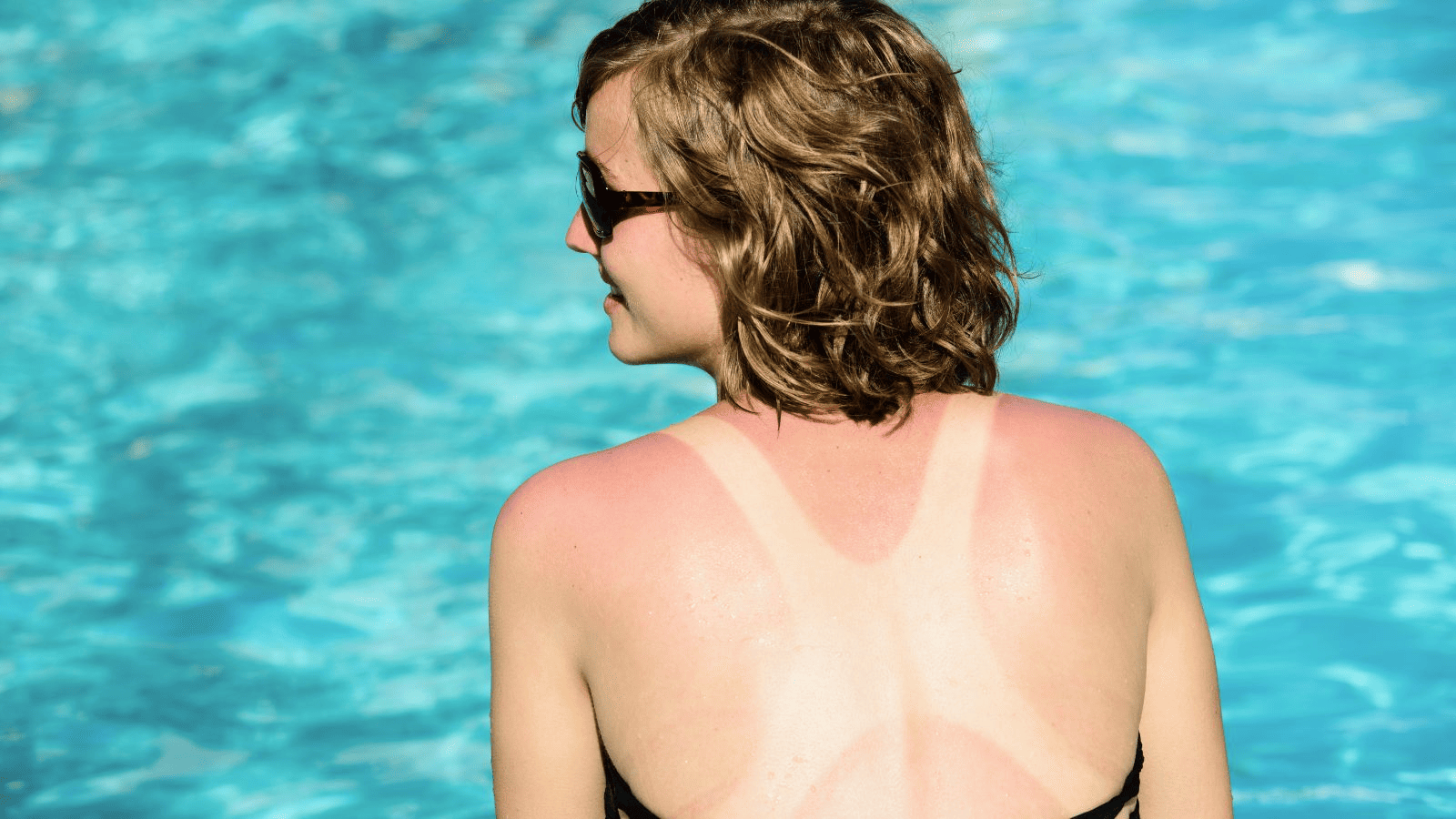 Cómo aliviar quemaduras de sol: guía efectiva y productos naturales
